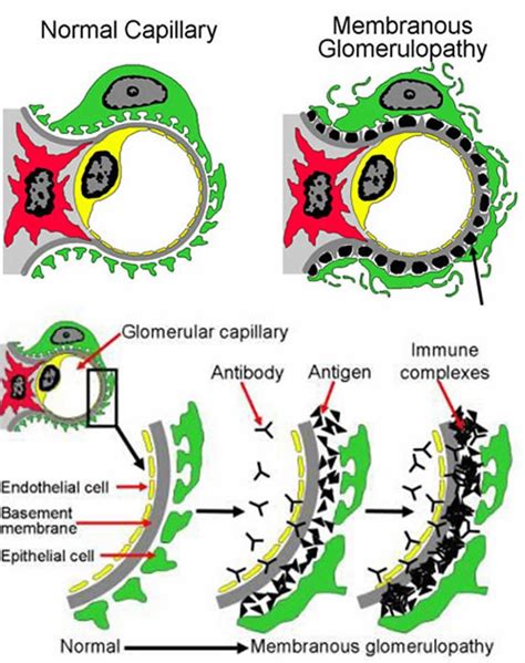 Understanding Membranous Glomerulonephritis: Causes, .